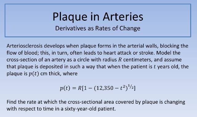 Plaque in Arteries 640